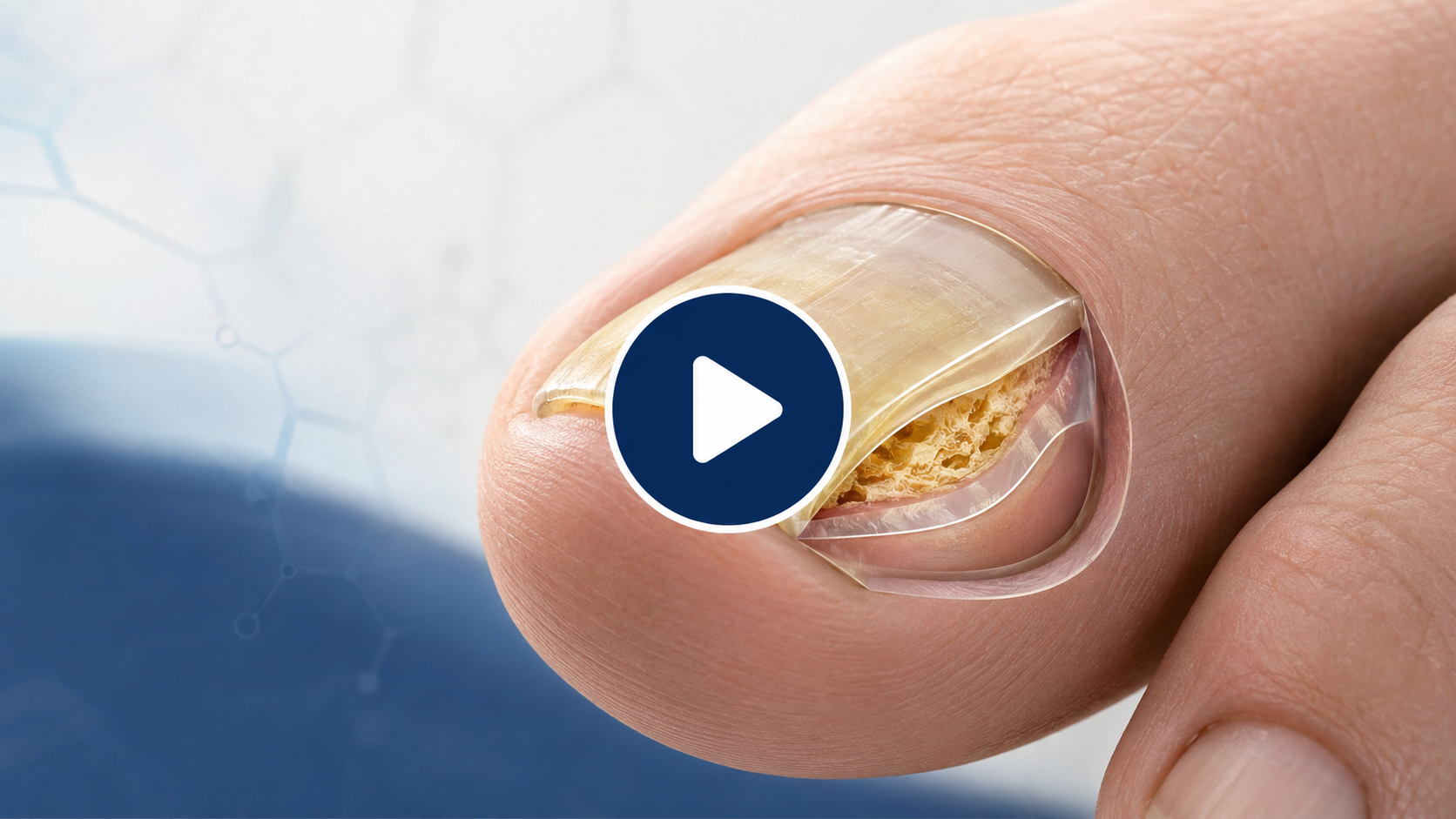 Illustration showing toenail fungus beneath the nail surface and extending into the nail bed.